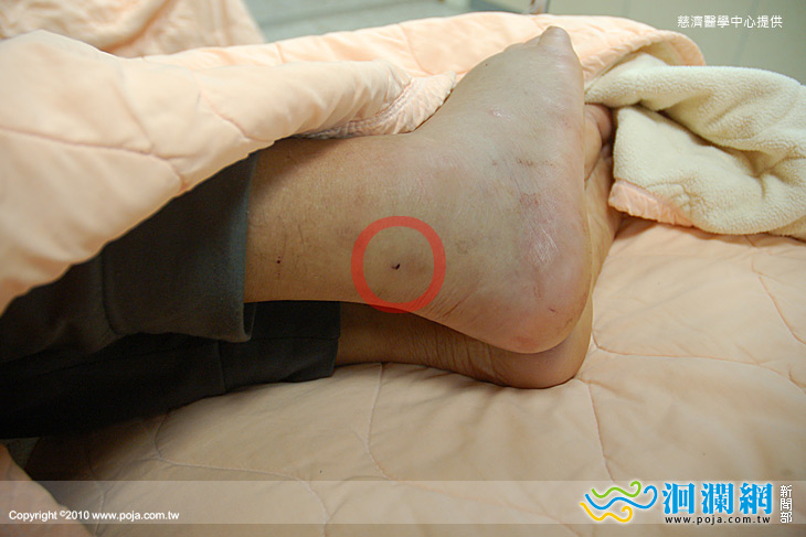 慘遭蛇吻別慌張，辨認種類快就醫