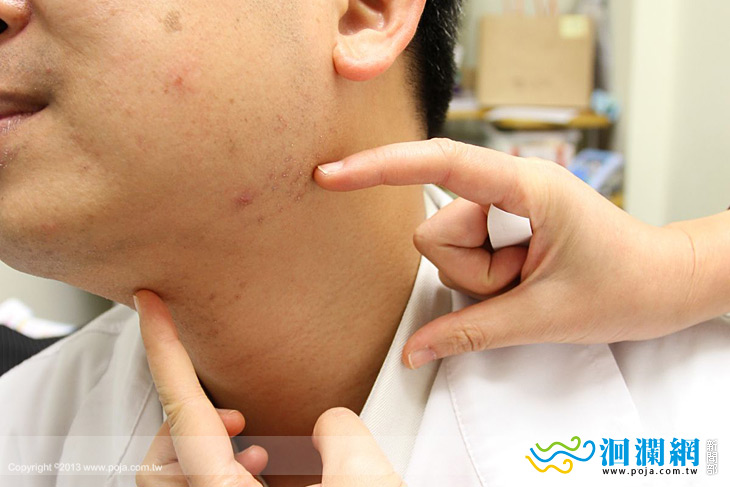婦人內頸動脈血管內膜剝離險中風  醫生：「太幸運