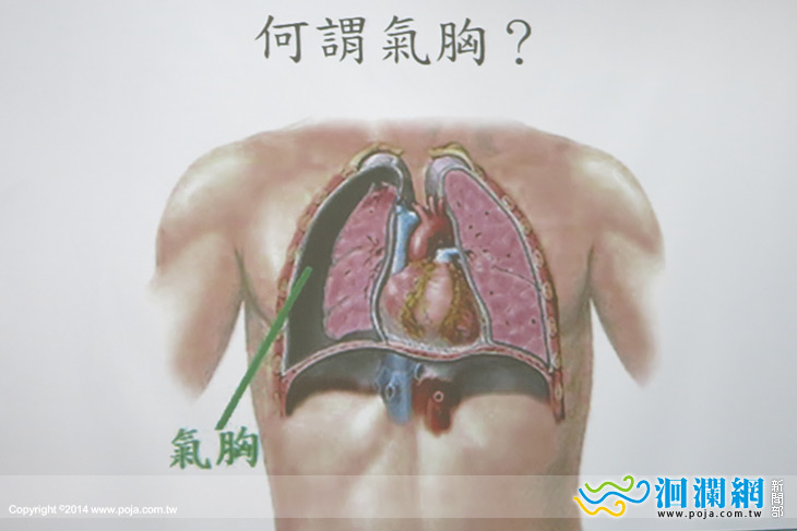 花醫氣胸-03.jpg