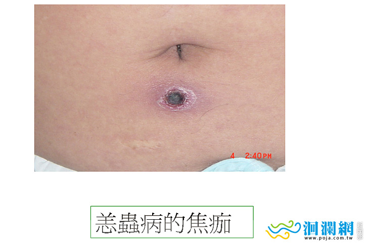 門諾恙蟲-03.jpg