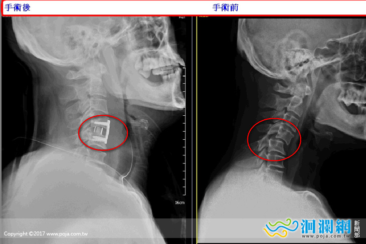 頸椎脫位快就醫，復位手術救神經