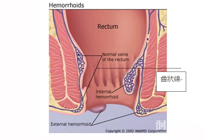 痔瘡-02.jpg
