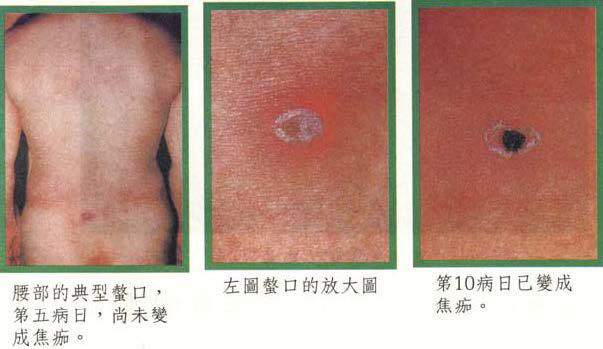 清明掃墓或出遊踏青避免恙蟲上身	