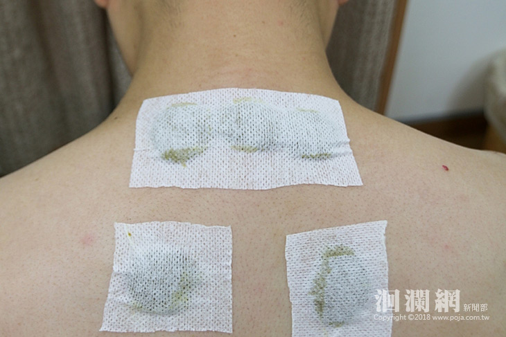 常常感冒、過敏別擔心，把握中醫三伏貼調體質