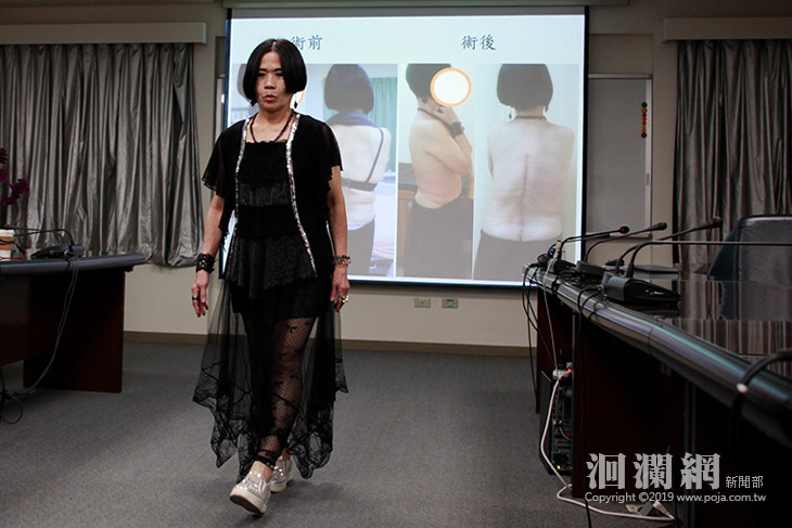 脊椎側彎變形矯正  67歲婦人：最想去旅行!