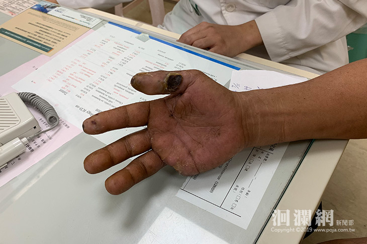 癮君子注意！ 患柏格氏症當心被截肢