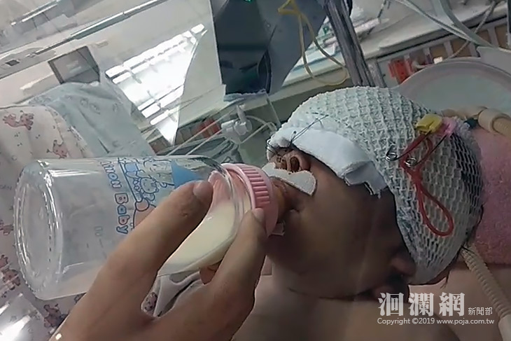 女嬰呼吸困難不喝奶，原來是後鼻孔嚴重狹窄