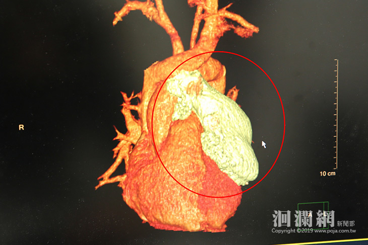 八公分胸腺瘤，香港青年跨海花蓮達文西手術醫治