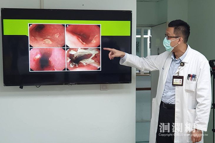 認識「藥物性食道炎」之診斷和預防-花蓮醫院