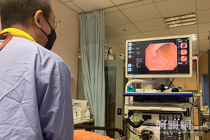 大腸癌初期幾乎無症狀  定期篩檢抓出癌兆