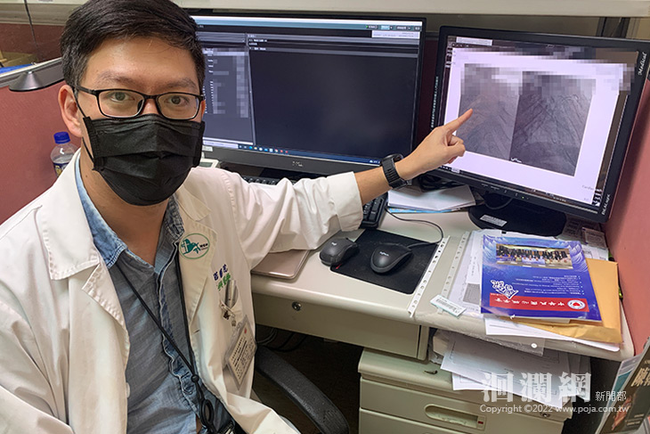 8旬老翁血管嚴重鈣化，冠狀動脈鑽石旋磨術有解